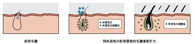 5个男人1个秃？快来了解雄激素性秃发的综合治疗