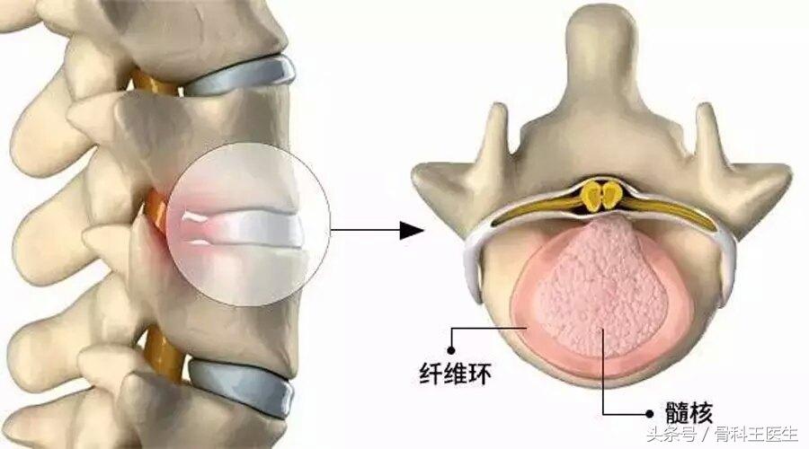 第四期，腰椎间盘突出你最该知道的事！