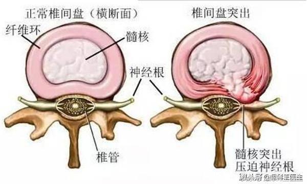 第四期，腰椎间盘突出你最该知道的事！