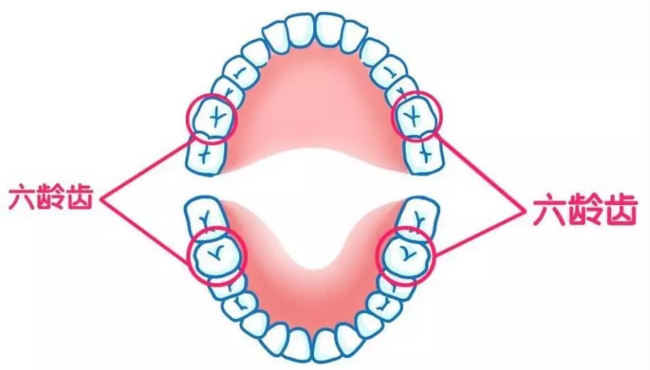 预防儿童龋齿涂氟还是窝沟封闭,有一点龋齿不想做窝沟封闭会怎样