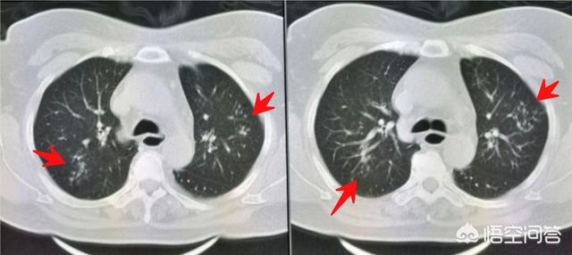 胃胀反酸导致嗓子发炎咳嗽,咽喉肿痛咳嗽吞口水都疼