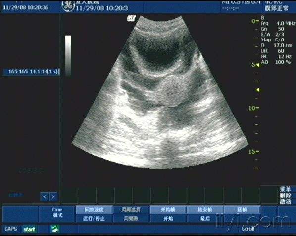 肝硬化腹水和肾炎腹水症状,引起腹水的病因都有哪些