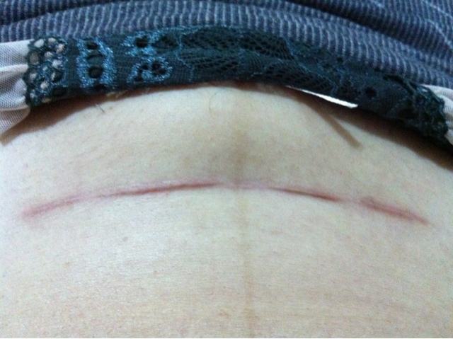 剖腹产刀口疤痕都是多久消失的,剖腹产疤痕刚开始是什么样的