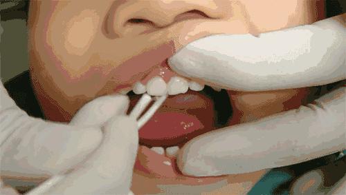 儿童牙齿严重龋齿最好的解决方法,乳牙龋齿防治的措施