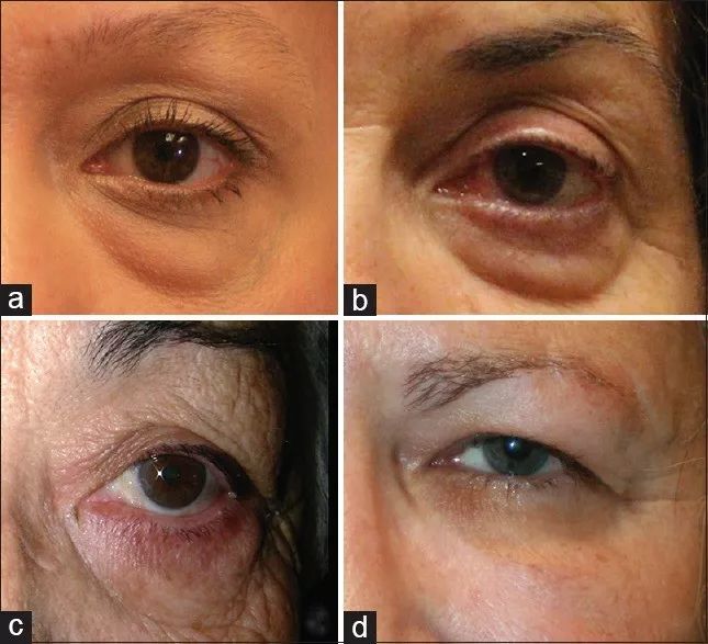 如何预防黑眼圈,青色黑眼圈和褐色黑眼圈哪个严重