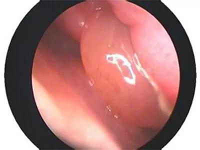 得了鼻息肉闻不着味儿怎么办,判断鼻息肉最简单方法