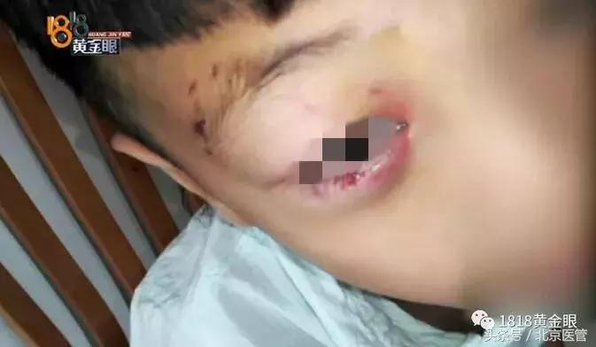 六岁男童被狗咬狂犬病发作后续,男子确诊狂犬病身亡几年前被咬过