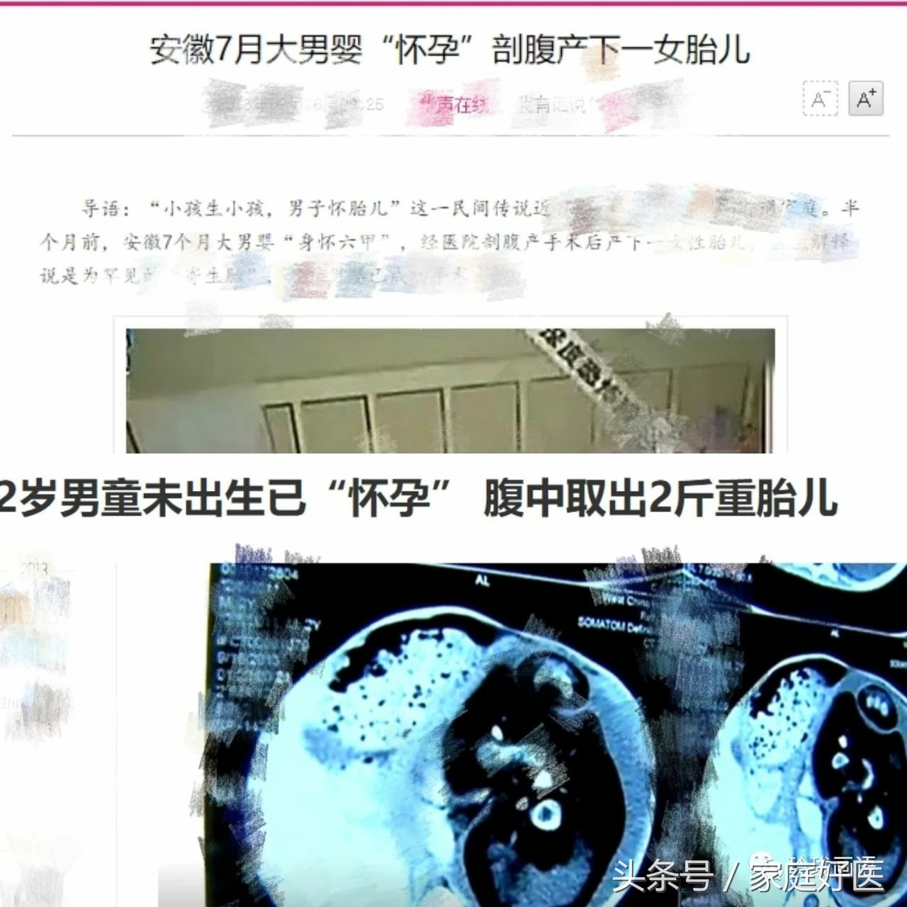 怀双胞胎一个会被另一个吸收吗,双胞胎吃掉另一个胎儿