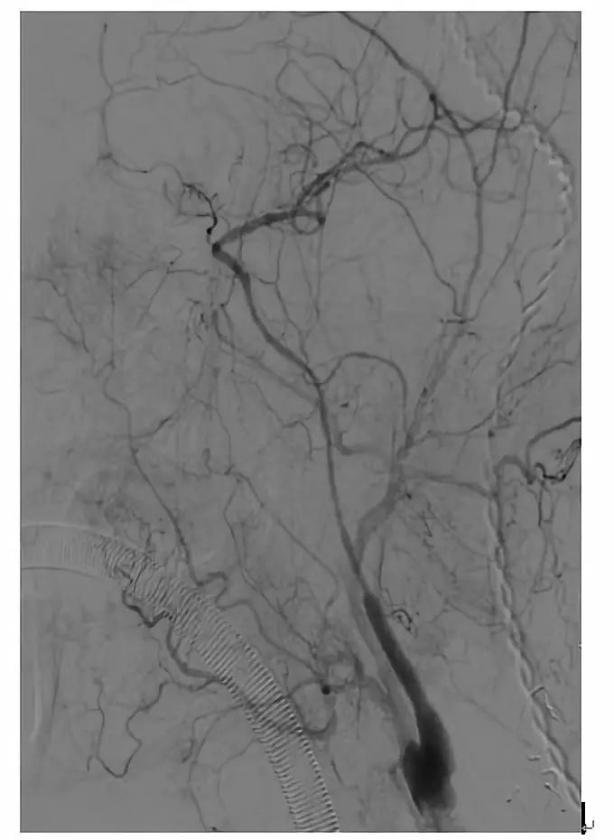 学术快报｜莫大鹏：颈动脉病变的复合手术治疗原则