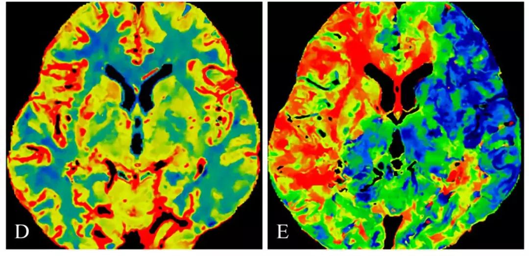 学术快报｜莫大鹏：颈动脉病变的复合手术治疗原则