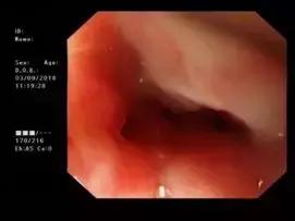 食管癌吞不下饭怎么办,食管肿瘤吃不下东西怎么减轻痛苦