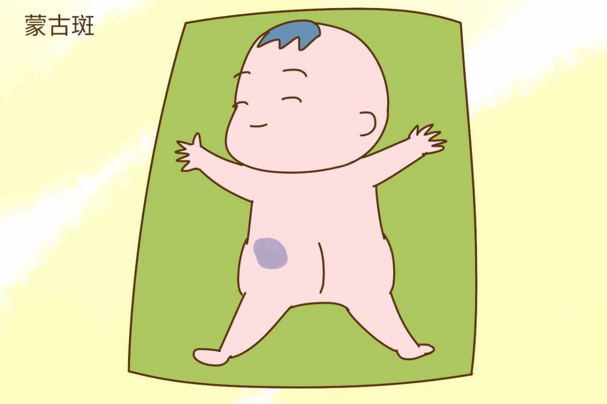 宝宝屁股上有青印,宝宝屁股上有划痕是什么情况