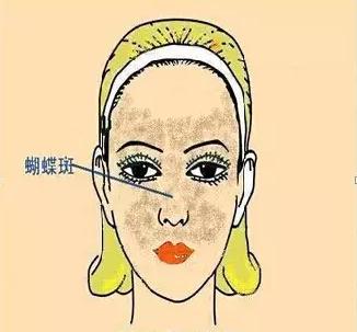 如何识别各种不同的斑,不同位置的色斑叫什么