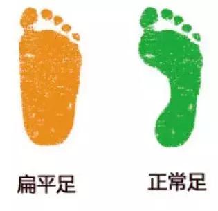 治疗扁平足最佳的鞋,什么样的鞋子可以预防扁平足