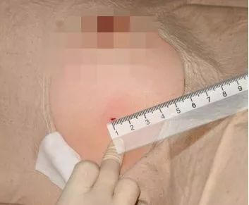 徐州哪个医院做乳腺微创手术最好,医大一院乳腺微创手术谁做的好