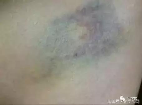 喝酒后皮肤变红逐渐变白是啥,喝酒后脸色会变白什么原因