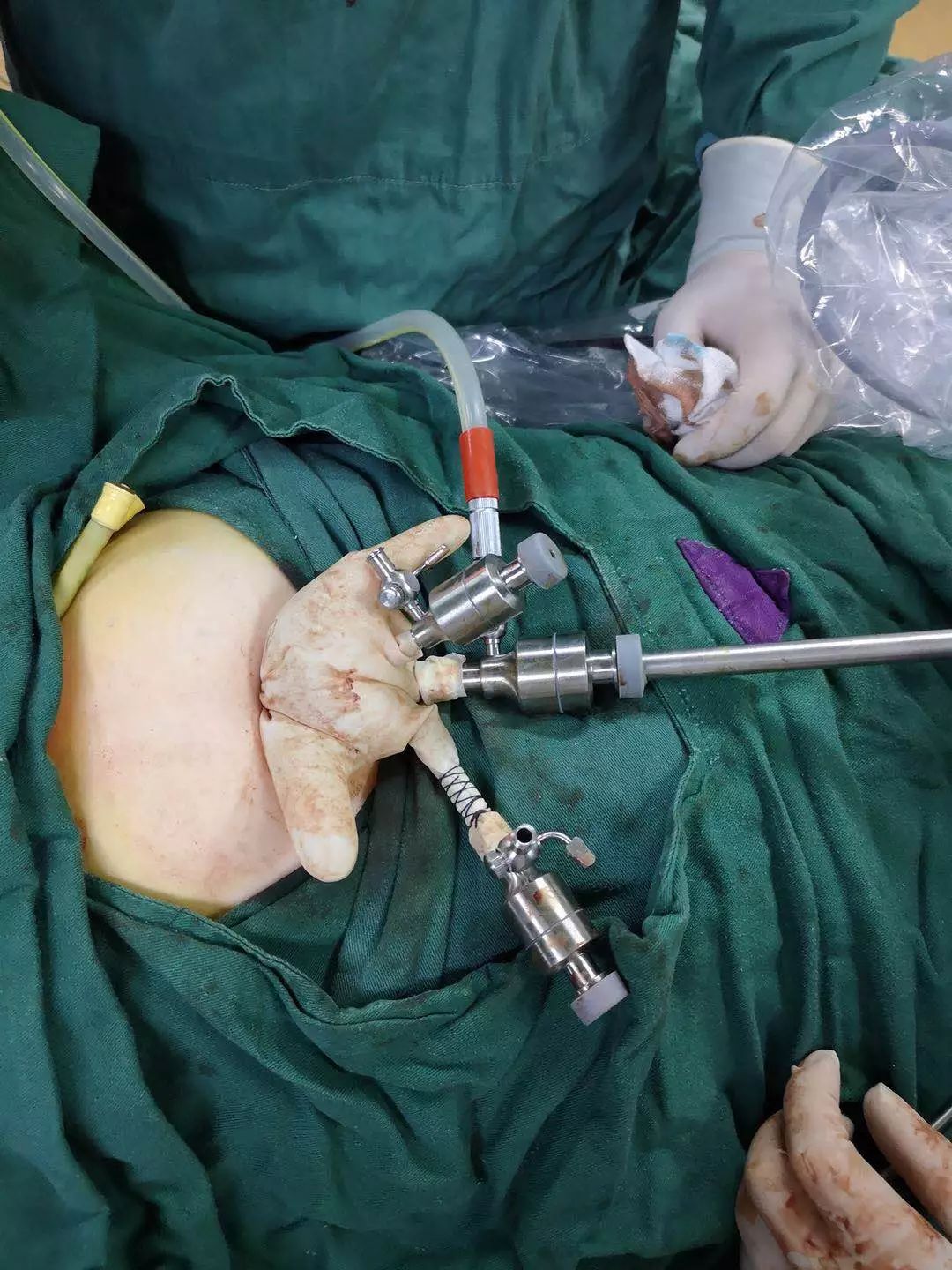 福州福兴妇产做腹腔镜,泉州福兴妇产医院剖宫产