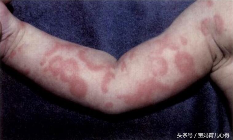 宝宝常见皮肤病家长们看过来,宝妈必须知道的五种皮疹