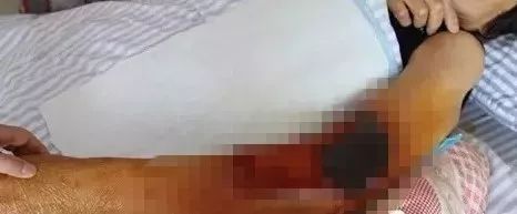 别不当回事！2人去世，1人截肢保命！只因被大家都爱吃的东西扎了一下