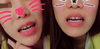 网上缺牙补贴是真的吗,缺牙人士看过来种牙补贴免费领