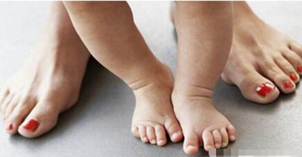 孩子走路外八字原因,孩子走路外八字怎么纠正过来