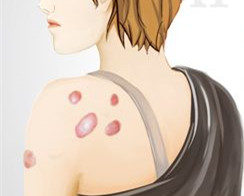 耳洞增生凸起疤痕疙瘩怎么处理,耳洞疤痕疙瘩涂什么药