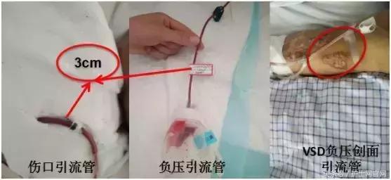 两条生命线一粗一细,两条生命线一细一粗