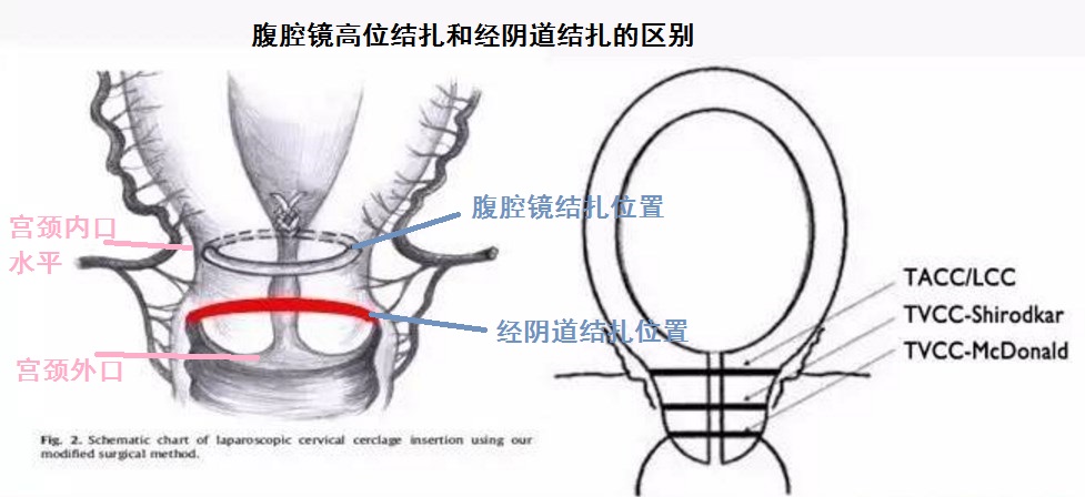 宫颈机能不全是不是容易痛,宫颈机能不全好治吗