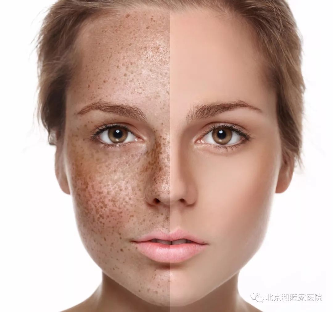 用皮秒激光祛色斑没有结痂,缩毛孔超皮秒和点阵激光哪个好