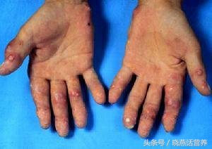 痛风急性发作期能吃海带吗,痛风患者可以适量吃磷虾油吗