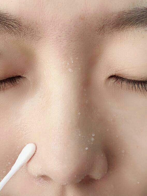 小孩黑头怎么去除最有效的方法,脸上黑头粉刺毛孔粗大怎么去除