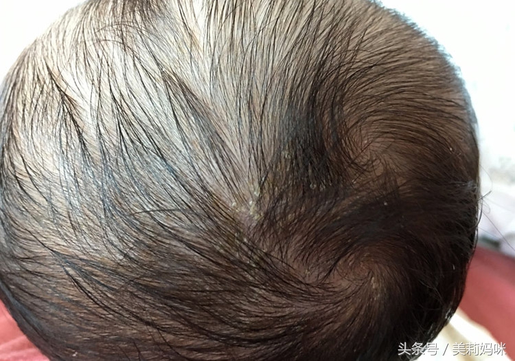 新生儿乳痂如何清除,如何处理新生儿脸上的乳痂