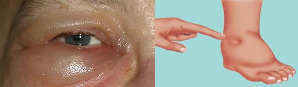 心源性水肿和肾源性水肿的区别,心源性水肿和肾源性水肿区别