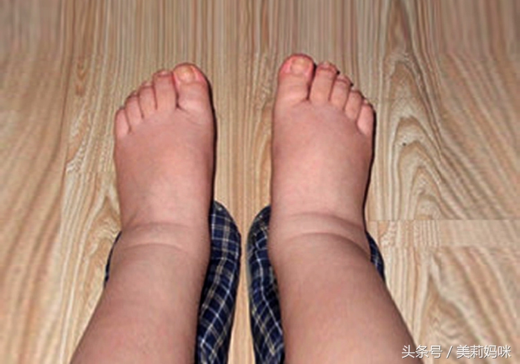 临产前水肿缓解是不是快生了,怀孕出现水肿一般是在第几周