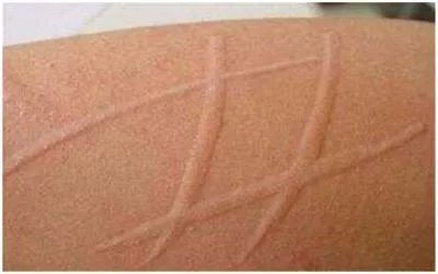 宝宝出疹误当普通过敏险致命？*麻疹荨**不寻常，熟记几大特征！