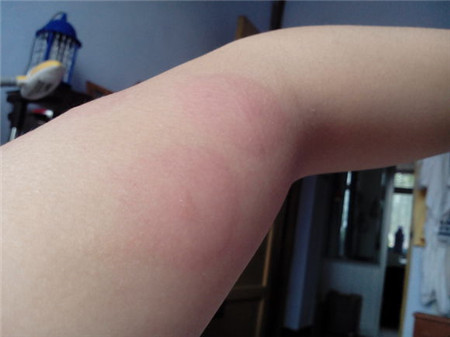 接触过麻疹病人多久排除传染可能,小孩子出麻疹要怎么预防传染呢