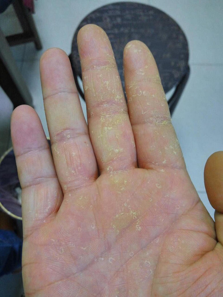 天气转凉了注意保暖的句子,天气转暖了开始长冻疮