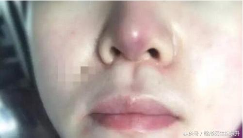 医生不会说的真相,隆鼻后鼻尖一直红是怎么回事