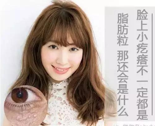 儿童脸上长一粒粒小疙瘩像脂肪粒,宝宝脸上起的类似脂肪粒的疙瘩