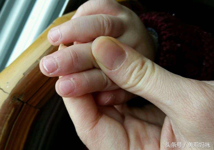 孩子手指起倒刺治疗小妙招,宝宝手指长倒刺怎么办