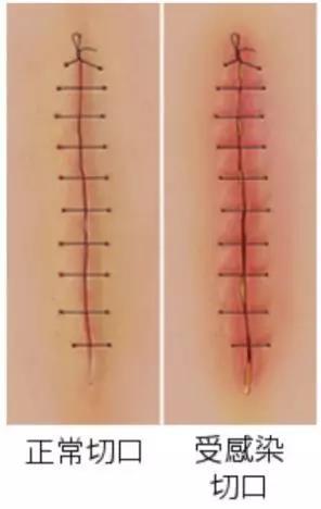 剖腹产后关键几天，产妇该如何护理？这些事儿很重要！