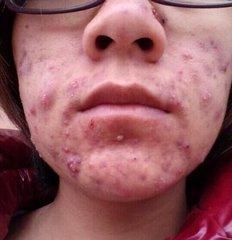 寻常疮怎么治,寻常痤疮用什么药膏