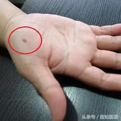 身上的痣会不会癌变一张图告诉你,身体上7种痣容易癌变