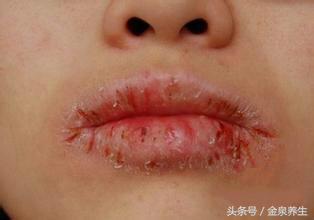 冬季嘴唇干裂适合喝什么汤,冬季孩子嘴唇红肿干裂老是舔