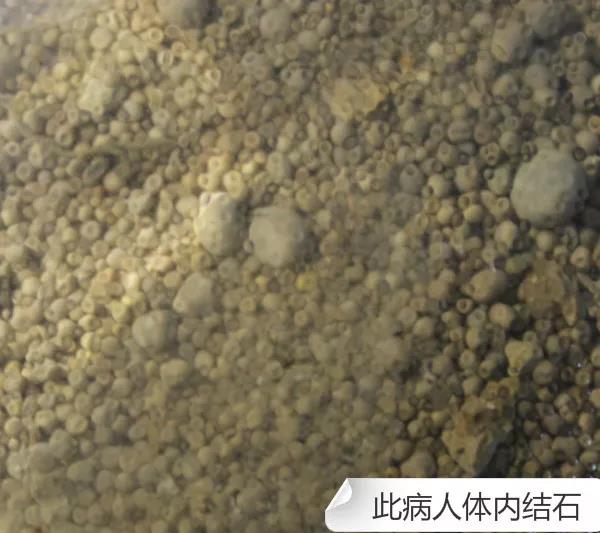 有冶肾结石肾囊肿的好医生吗,肾结石外科手术治疗最新方案