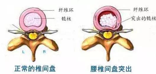 腰突保守治疗8月后还有症状,腰痹通胶囊治疗腰突效果怎样