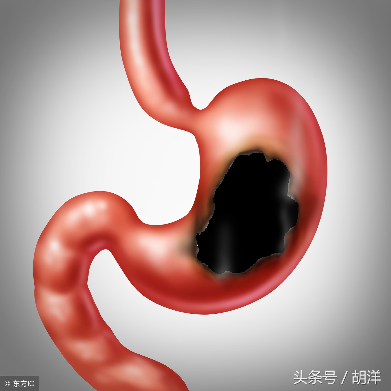 胃黏膜损伤能吃什么药止疼,保护胃黏膜吃啥药好得快