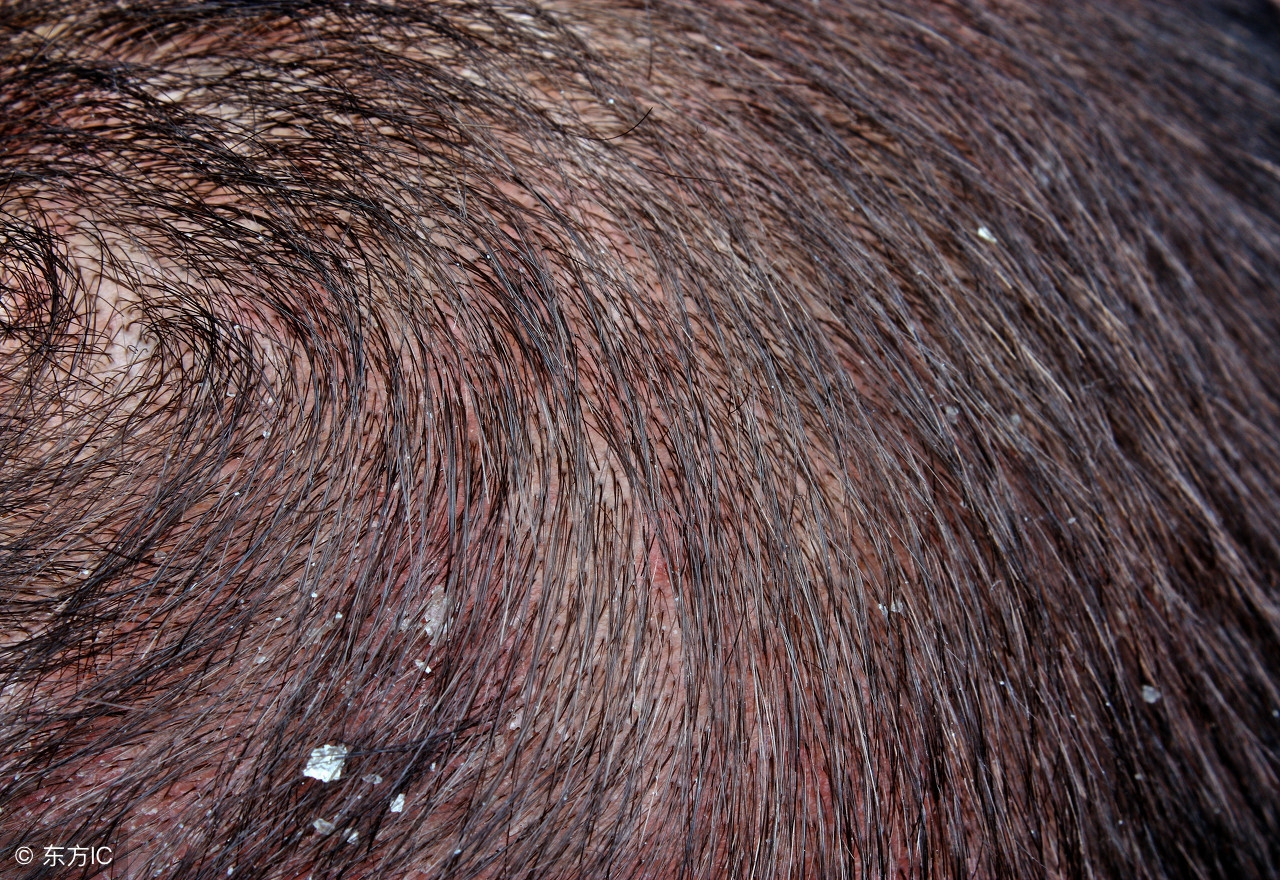 头皮冬天干燥补水的最佳方法,头皮干燥救星