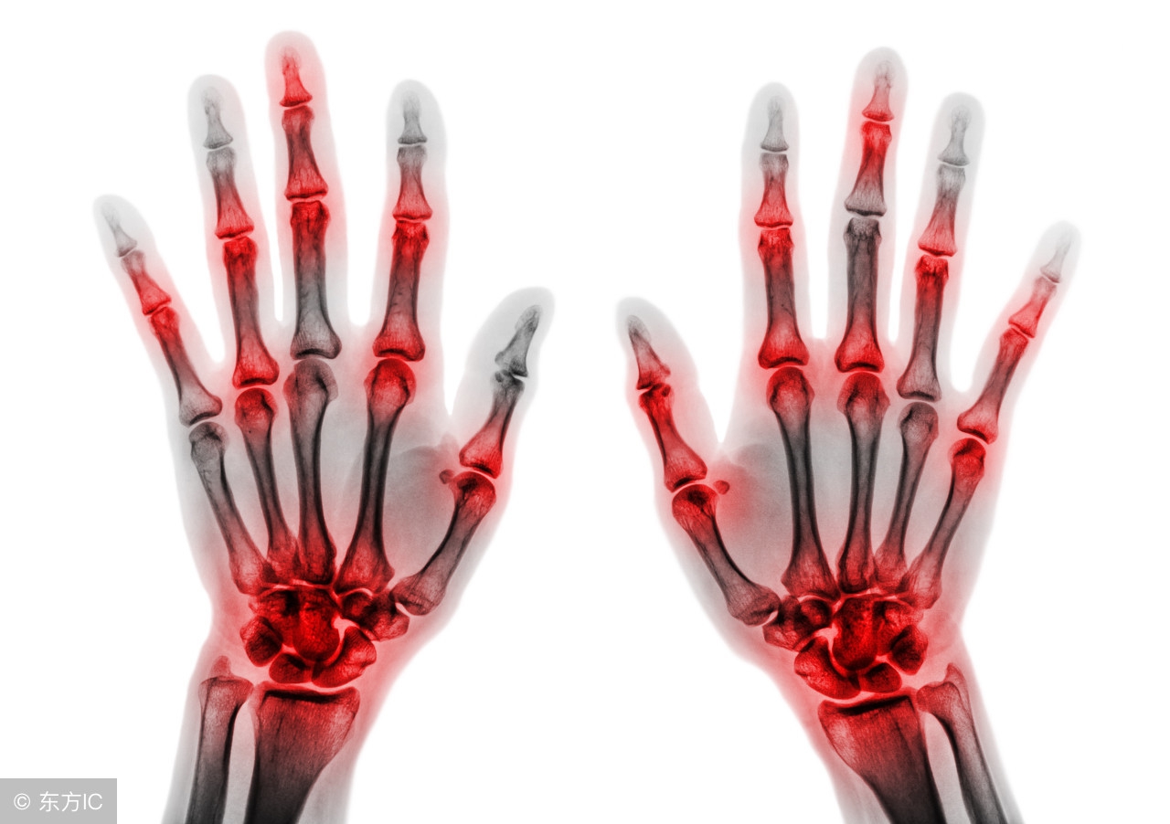 打针能治愈类风湿吗,初期打生物制剂能治类风湿吗