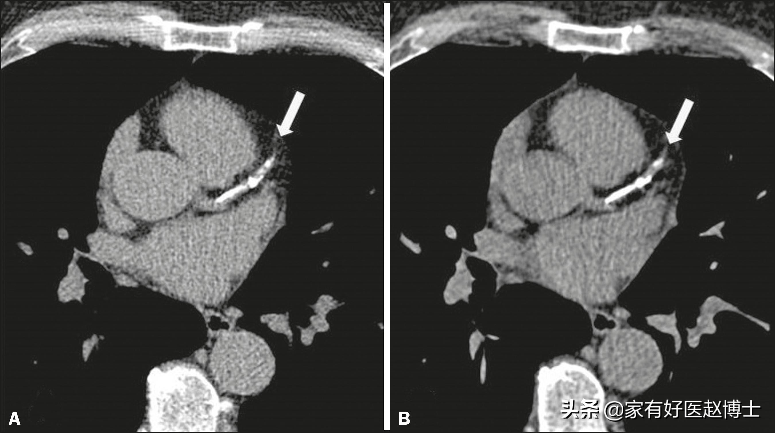 减缓血管老化做好以下几点,老人血管老化可以吃安宫牛黄丸吗